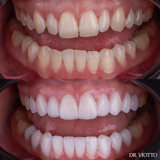 Clareamento dental de longa duração e resultado real