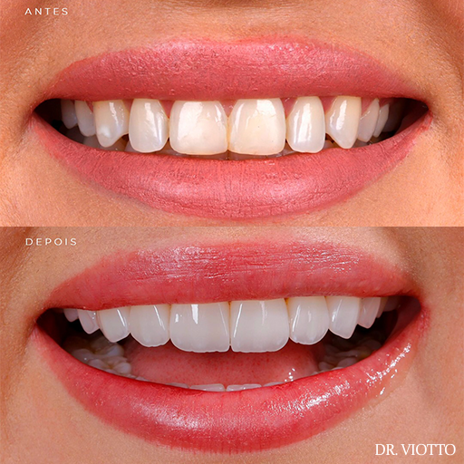 Clareamento dental de padrão premium