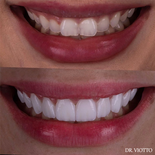 Facetas estéticas com mínimo desgaste