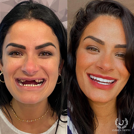 Harmonização do sorriso com procedimentos modernos
