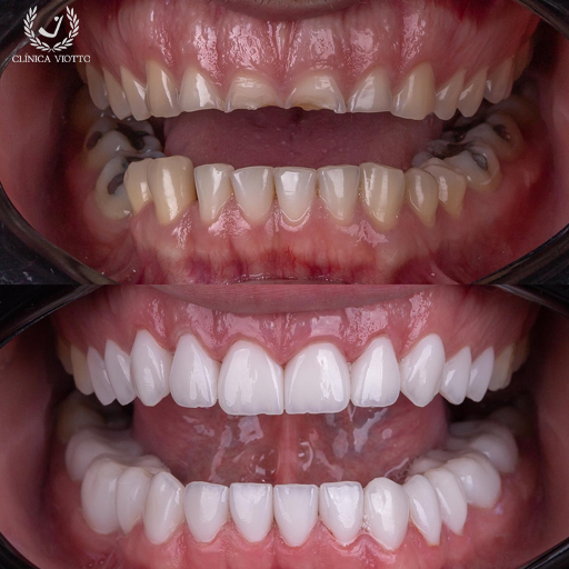 Harmonização do sorriso com procedimentos modernos