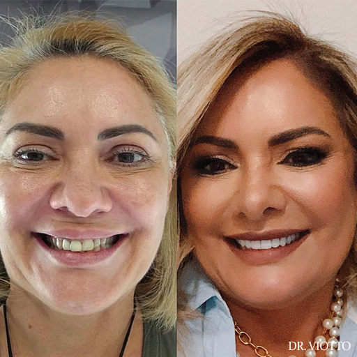 Harmonização Facial Viotto Natural Harmonização Facial Viotto Natural