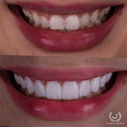 Lentes de porcelana: veja antes e depois de pacientes