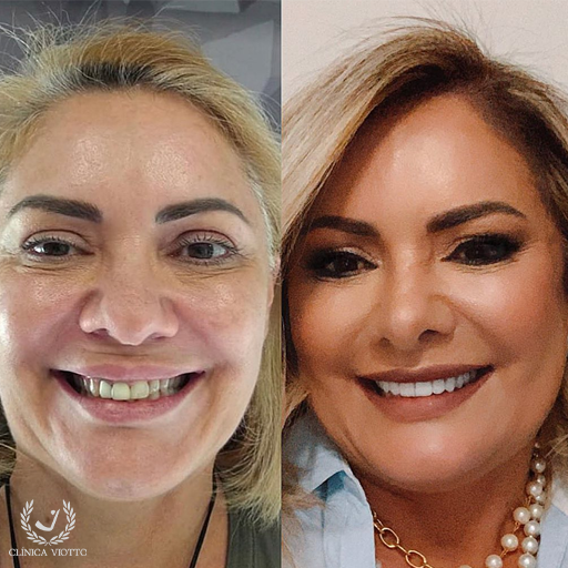 Reabilitação estética dental