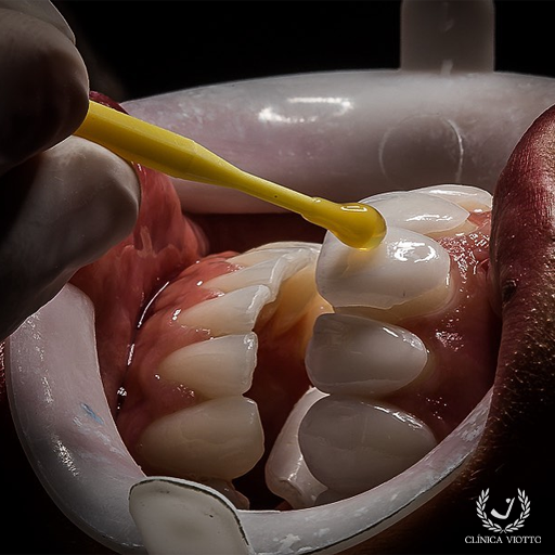Sorriso em porcelana com aparência natural e elegante